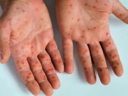 Dangerous Outbreak! Measles Surges in Texas, 18 Hospitalized